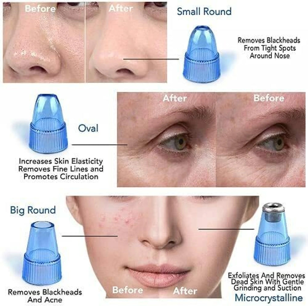 4-in-1 Derma Suction Whiteheads & Blackhead Remover