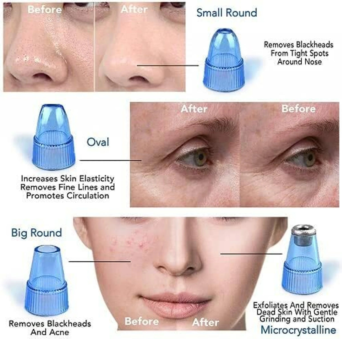 4-in-1 Derma Suction Whiteheads & Blackhead Remover